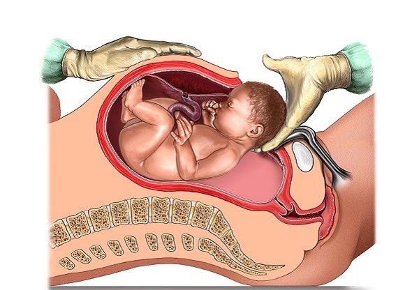 Các chấn thương sau khi sinh là nguyên nhân thường gặp nhất gây rò âm đạo